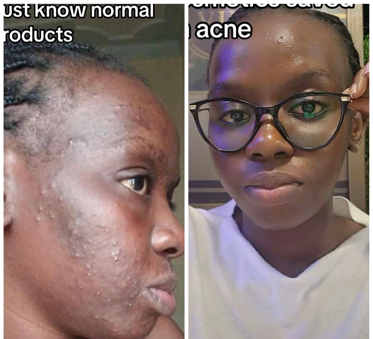 Acne scarring