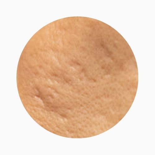 Acne scarring